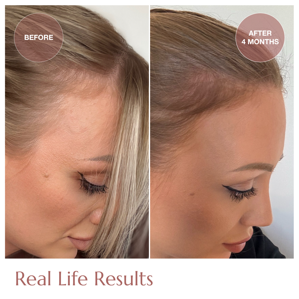 Advanced+ Hair Growth Starter Kit