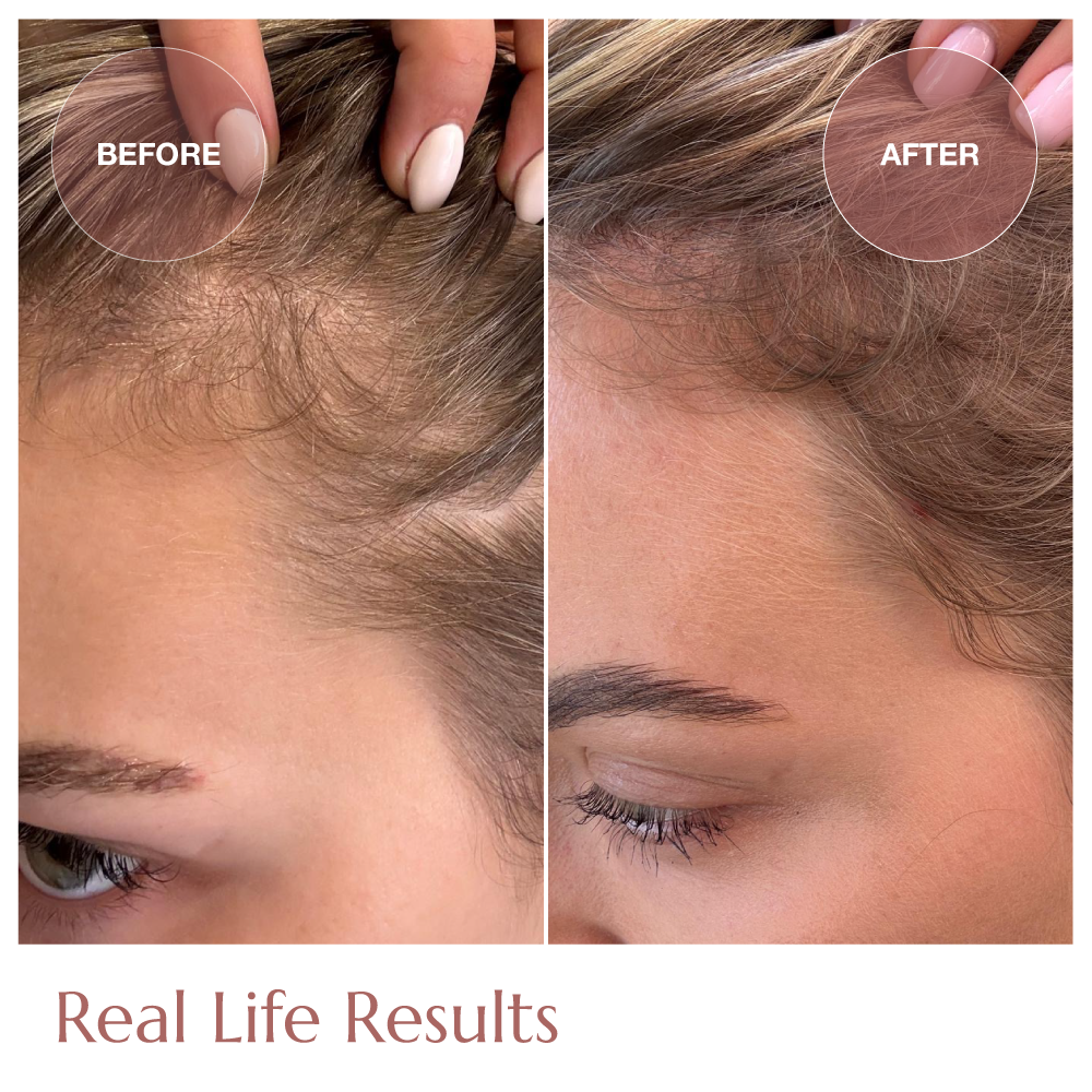 Advanced+ Hair Growth Starter Kit