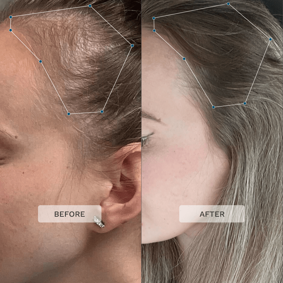 Before and after image showing hair growth around the temples after using Advanced+ Hair Formula