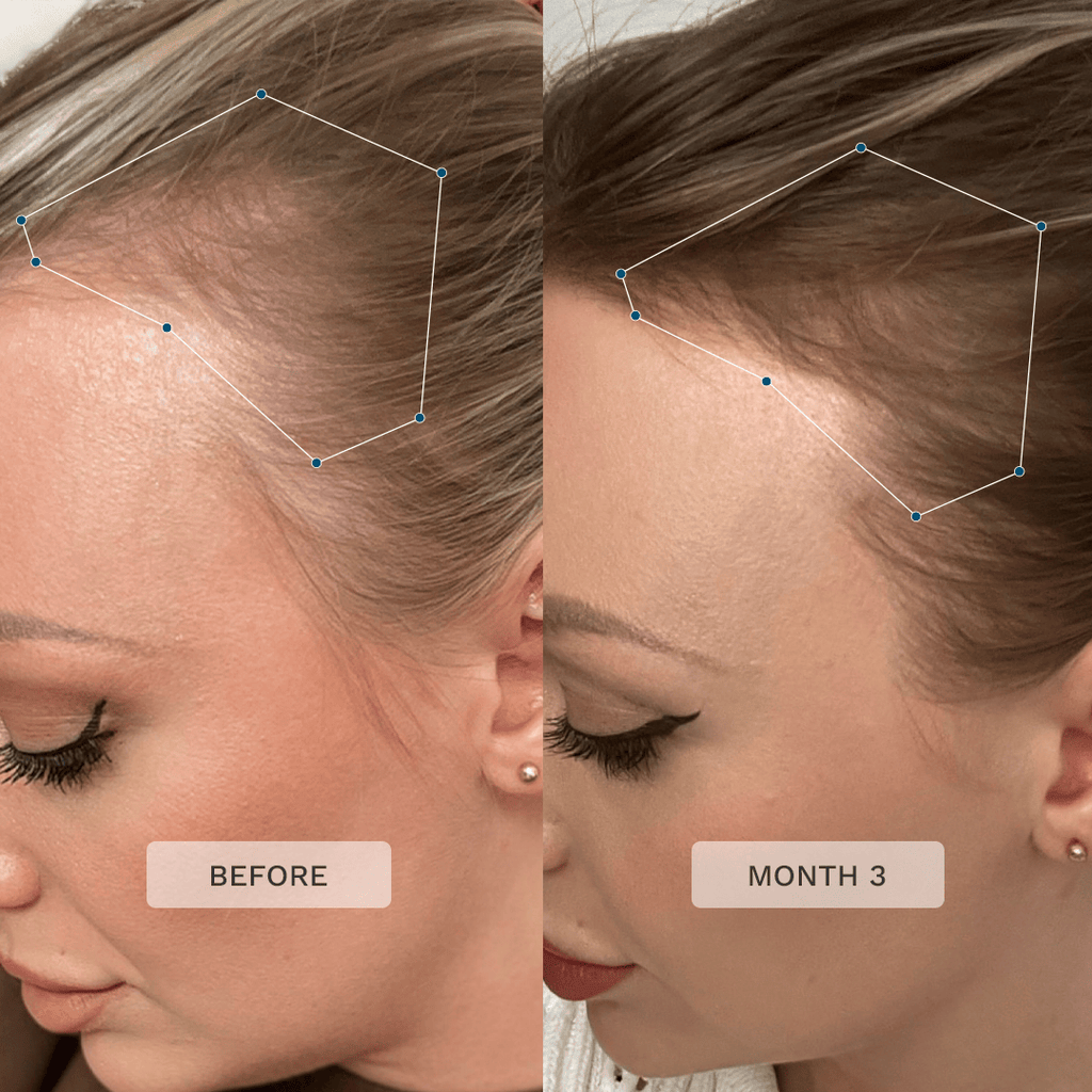 Before and after transformation image showing Kerri's hair growth after using Advanced+ Hair Formula